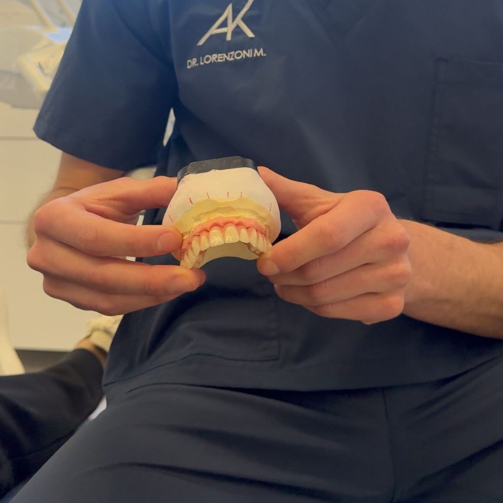 Benefici impianti dentali: perché sceglierli? - Impianto dentale a Anzola dell'Emilia - come si mette un impianto dentale
