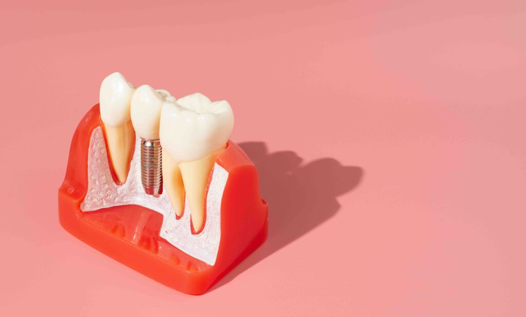 implantologia dentale a Anzola dell'Emilia