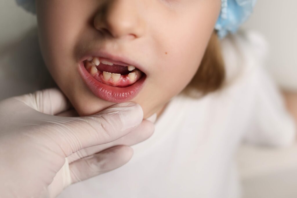 Quando cadono i denti da latte? Tutto quello che i genitori devono sapere 1 quando cadono i denti da latte a Anzola dell'Emilia