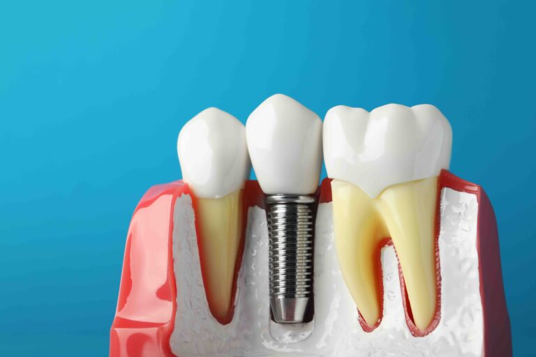 Blog 1 benefici impianti dentali a Anzola dell'Emilia