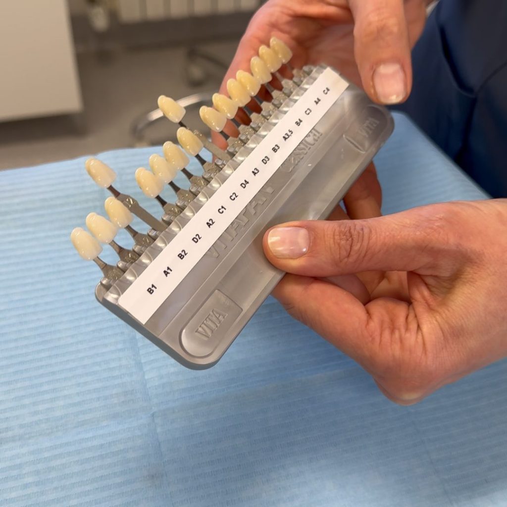 Faccette Dentali 1 FACCETTE - faccette dentali a Anzola dell’Emilia