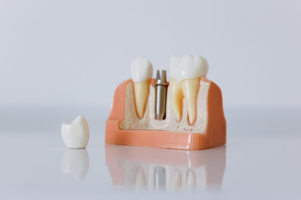 denti fissi in giornata