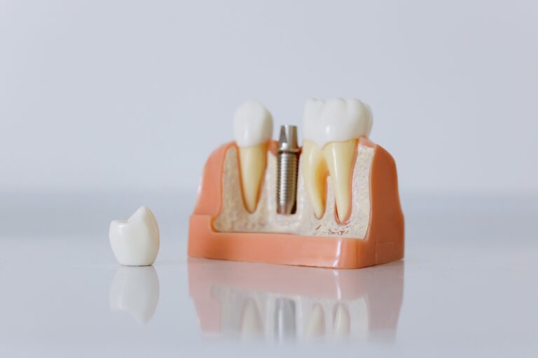 denti fissi in giornata